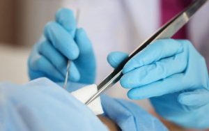 phẫu thuật chỉ dafilon